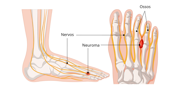 Neuroma de Morton